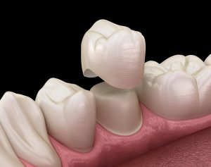 dental crown illustration